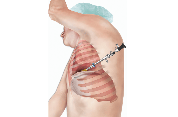 thoracoscopy